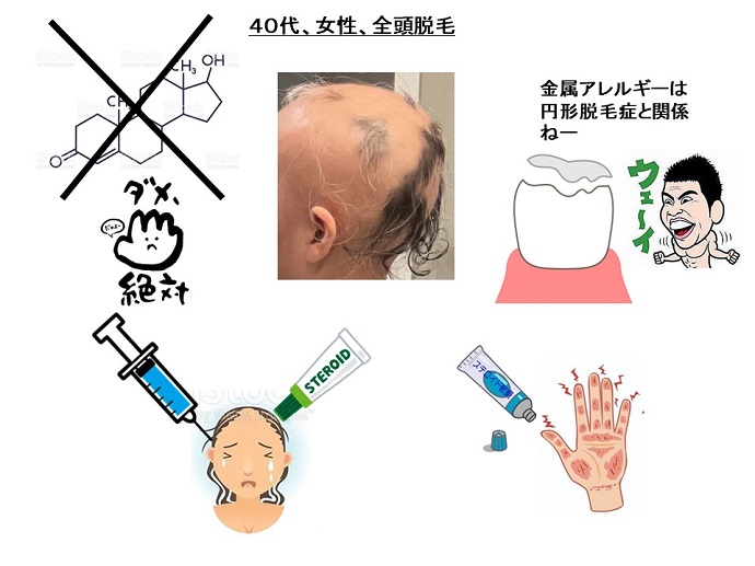 円形脱毛症　病院